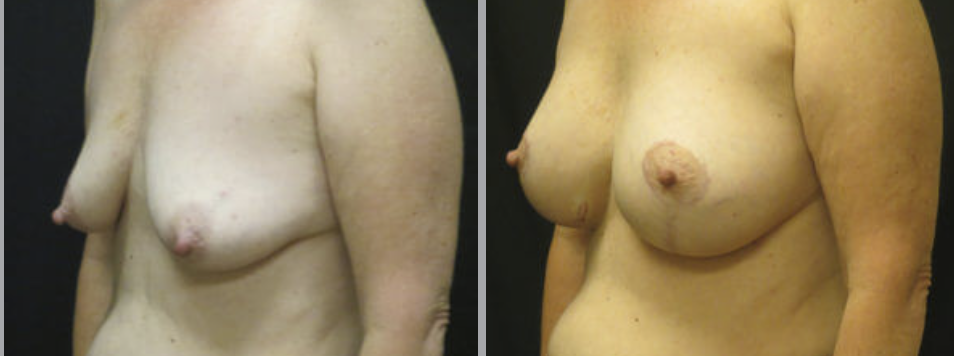 Breast Lift in Ventura, CA